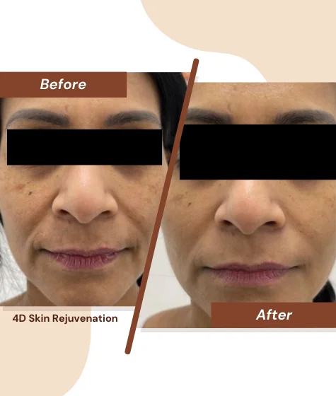 4D-Skin-Rejuvenation