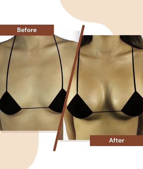 Breast-Enhancement-2