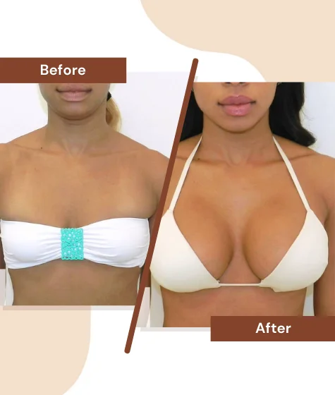 Breast-Enhancement
