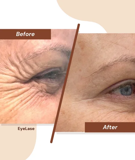 Eyelase-2