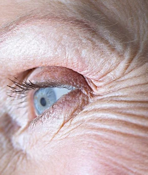 Eyelase