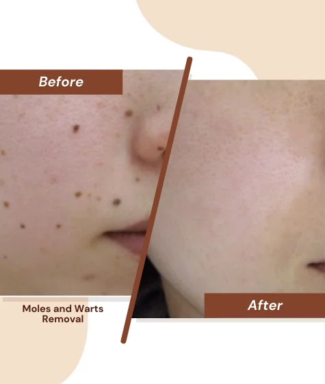 Moles-and-Warts-Removal-2