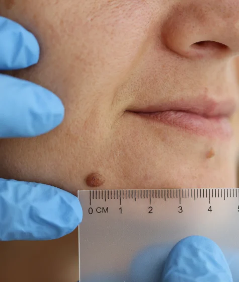 Moles-and-Warts-Removal