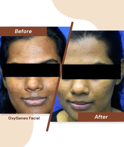 OxyGeneo-Facial-2