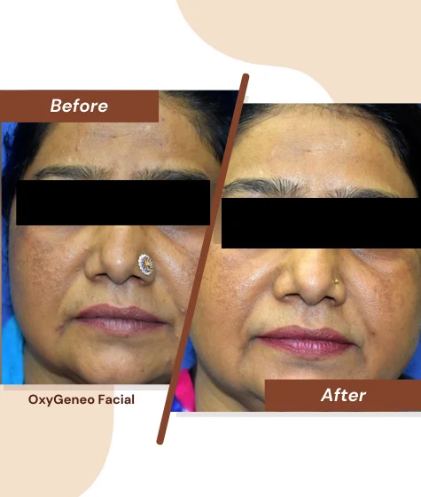 OxyGeneo-Facial