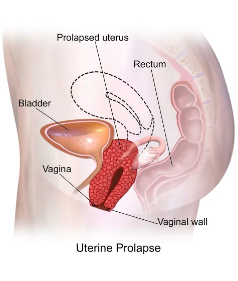 Pro-lapse-Uterus-and-Cystocoele