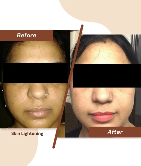 Skin-Lightenig