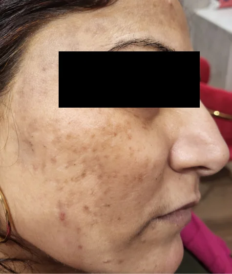 Skin-Lightening