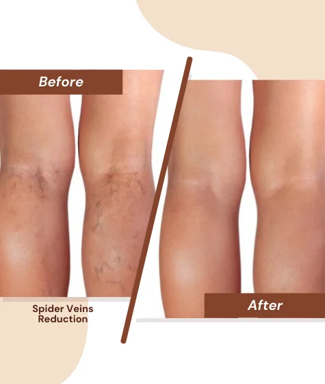 Spider-Veins-Reduction-2