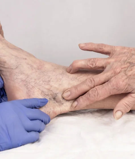 Spider-Veins-Reduction