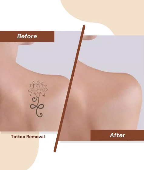Tattoo-Removal-2