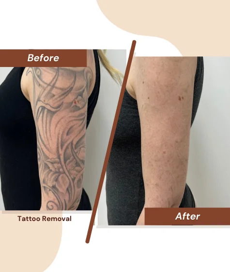 Tattoo-Removal