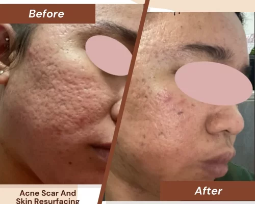 Acne-Scar-And-Skin-Resurfacing