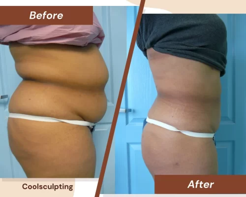Coolsculpting-2
