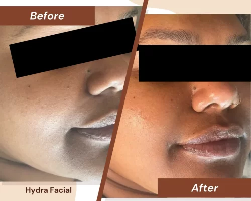 Hydra-facial-2