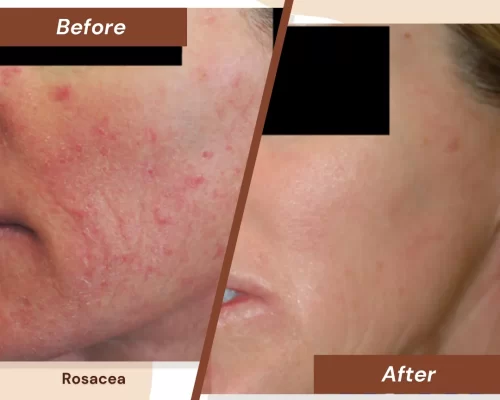 Rosacea