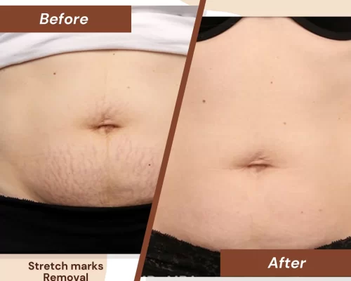Stretch-marks-Removal-2