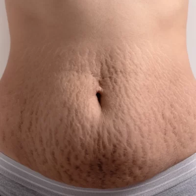 Stretch-marks-Removal